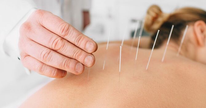 Acupuncture